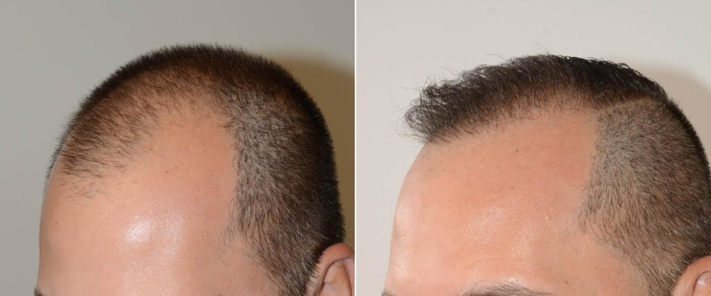 Patient 59634 - Foundation For Hair Restoration