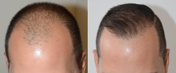 Trasplante de Pelo en Hombres Before and after in Miami, FL, Paciente 73961