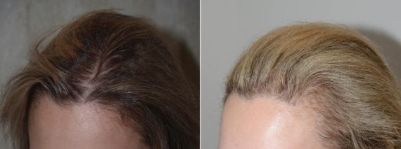 Trasplante de Pelo en Mujeres Before and after in Miami, FL, Paciente 98582