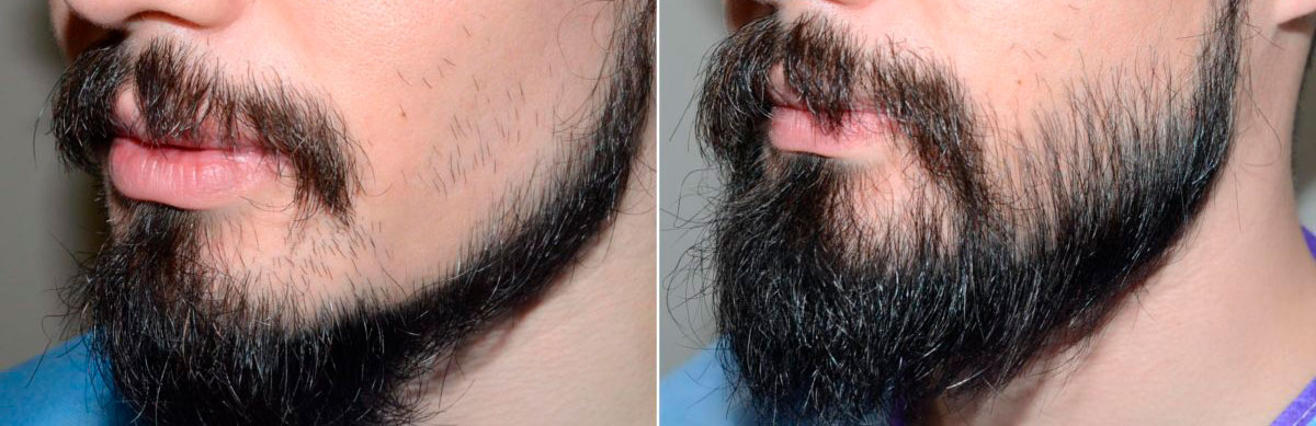 Before and after photos - Foundation For Hair Restoration