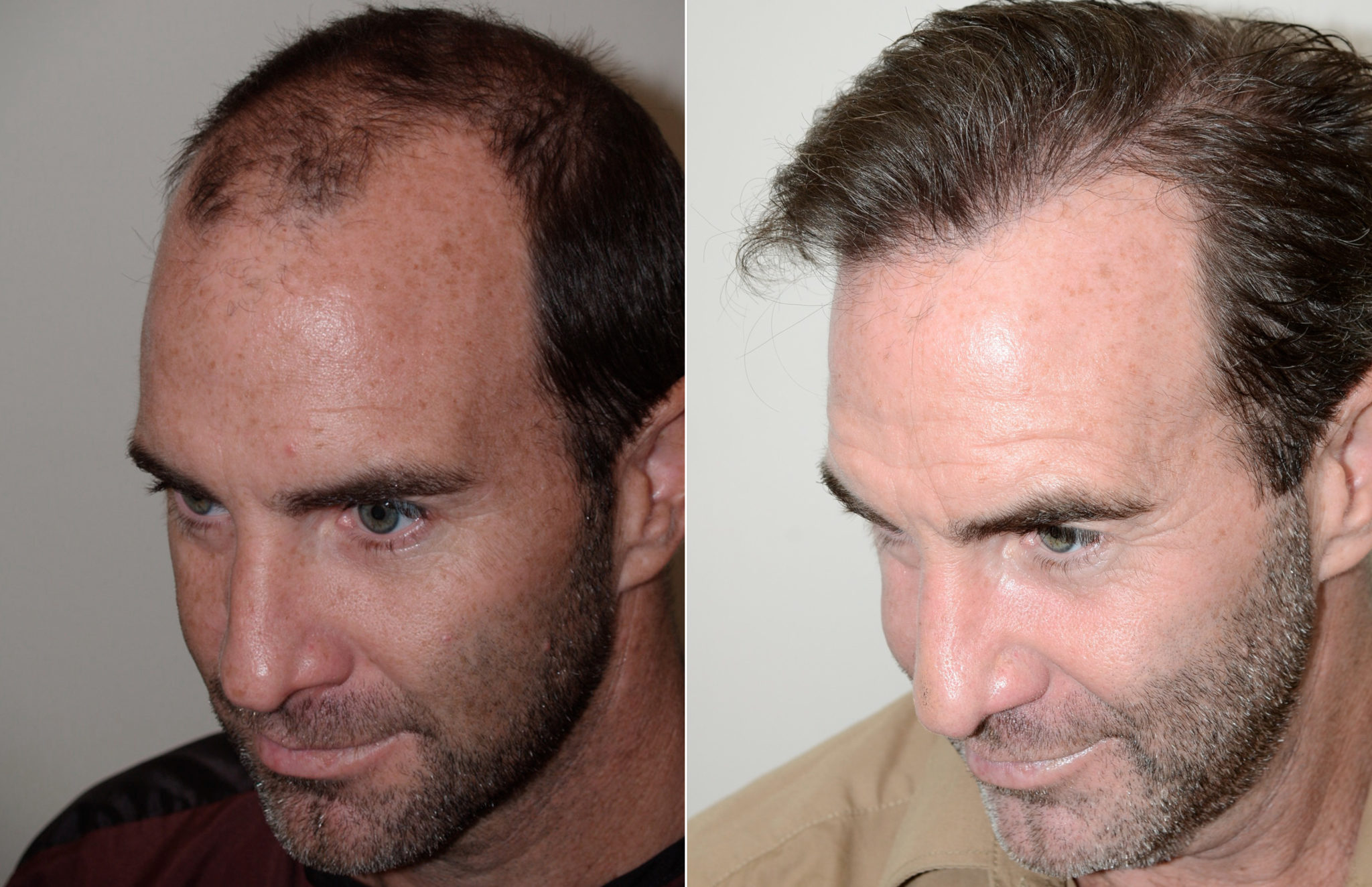 Male Hair Transplant before and after photos - Foundation For Hair ...