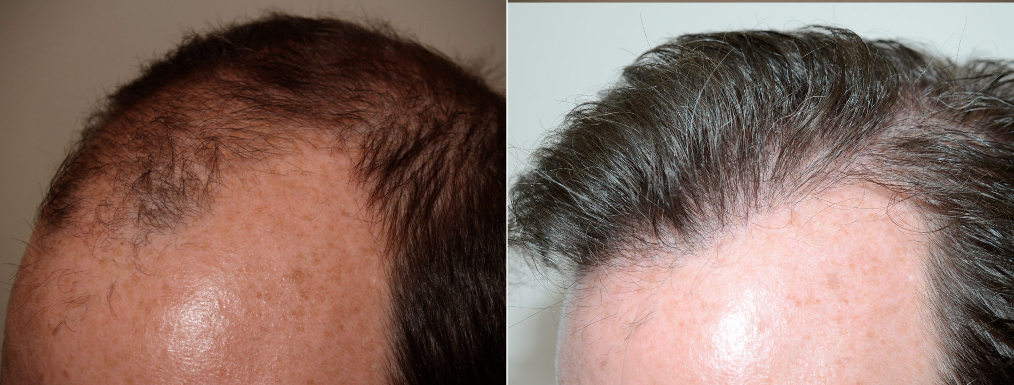 Male Hair Transplant photos | Miami, FL | Patient74093