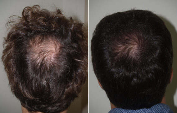 Hair Transplants for Men Before and after in Miami, FL, Paciente 94597