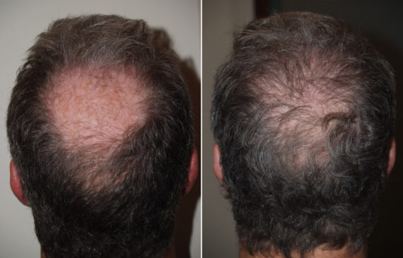 Hair Transplants for Men Before and after in Miami, FL, Paciente 94583