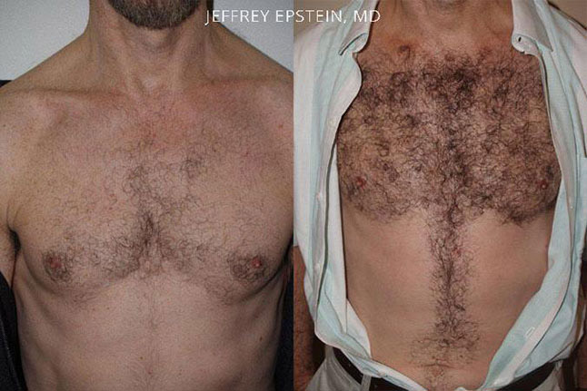 Body Hair Transplant Miami Fl