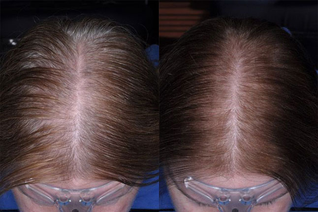 Stem Cell Therapy - Hair Restoration Clinic - The Hair Loss Doctors