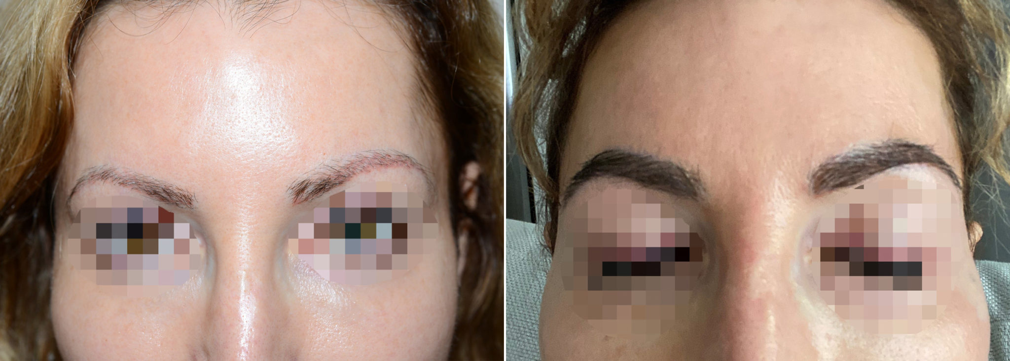 Eyebrow Hair Transplant Photos Miami Fl Patient108135