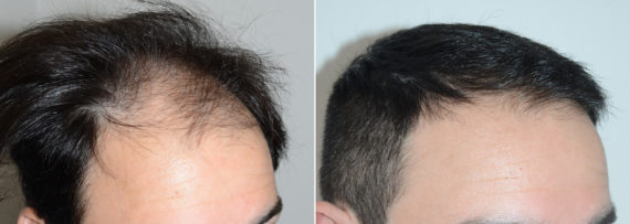 Trasplante de Pelo en Hombres Before and after in Miami, FL, Paciente 107988