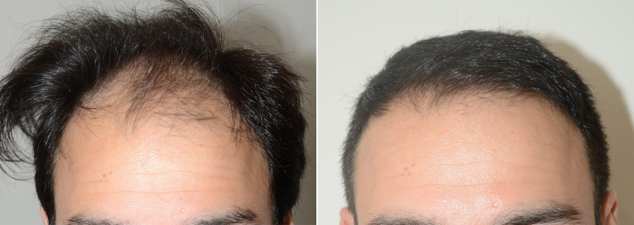 Hair Transplants for Men photos | Miami, FL | Patient107965