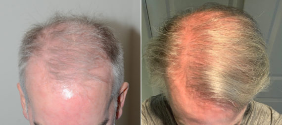 Trasplante de Pelo en Hombres Before and after in Miami, FL, Paciente 108344