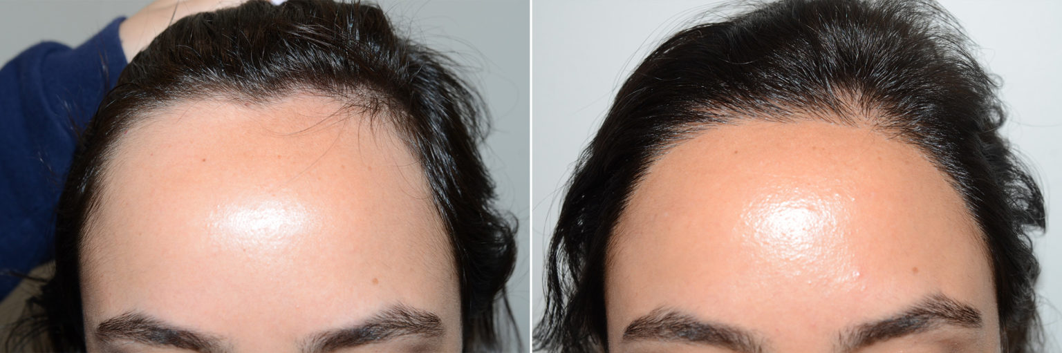 Forehead Reduction Surgery, Hair Transplants for Women photos | Miami ...