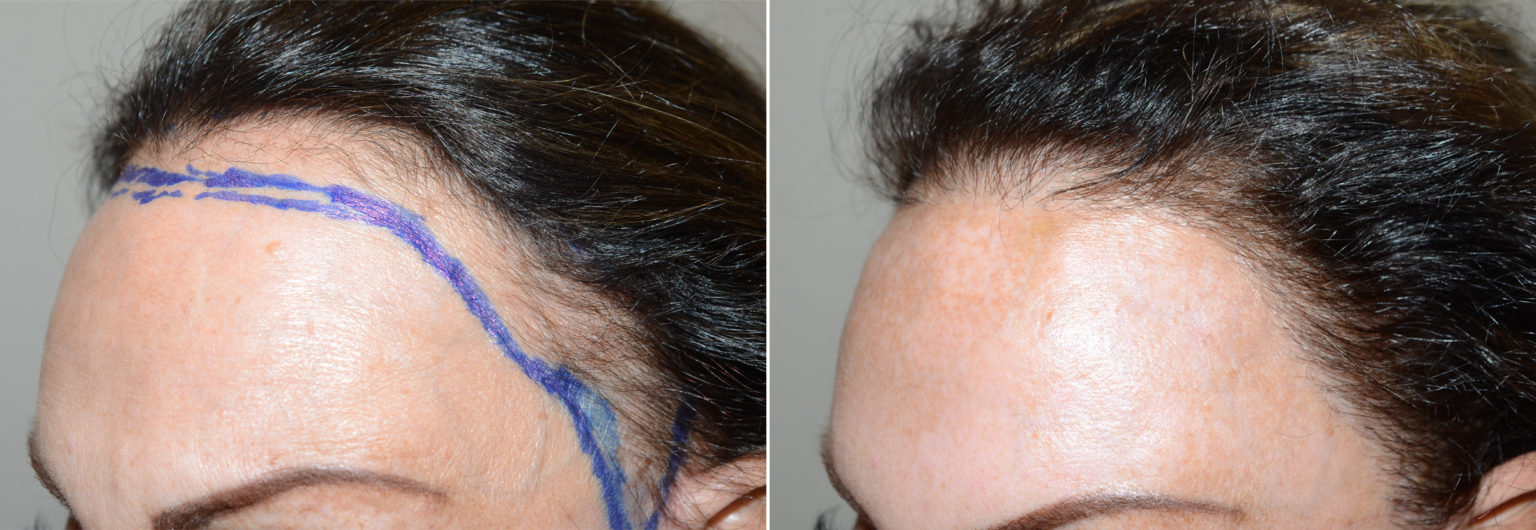 Hair Transplants for Women before and after photos - Page 5 of 14 ...