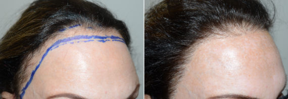 Trasplante de Pelo en Mujeres Before and after in Miami, FL, Paciente 108729