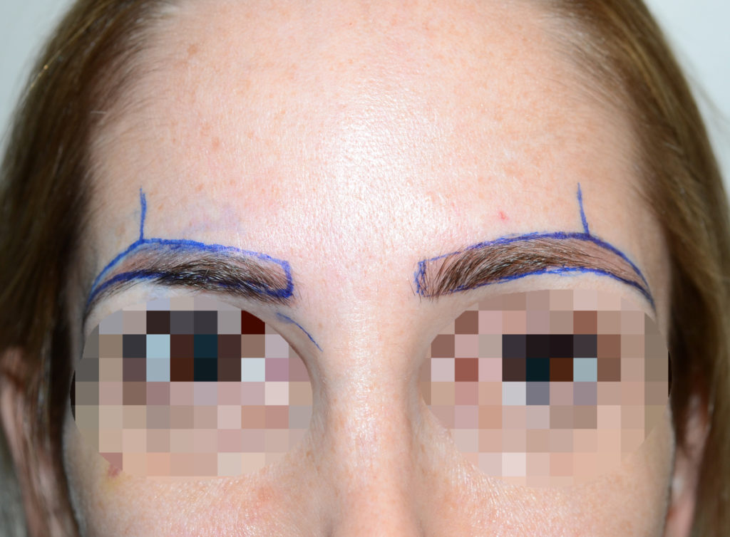 Eyebrow Transplant Eyebrow Hair Miami Fl Foundhair 2365