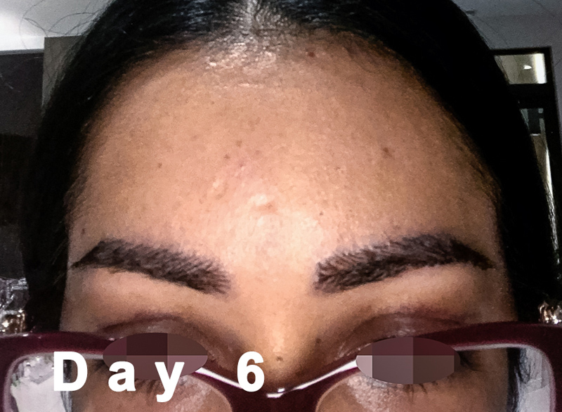 Eyebrow Transplant Eyebrow Hair Miami Fl Foundhair 4549