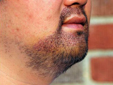 Four days after 800 grafts to the mustache and goatee in an Asian patient