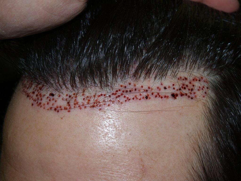 Before, two days after and one year after FUE removal of more than 700 unaesthetic prior placed grafts into the hairline marked photo