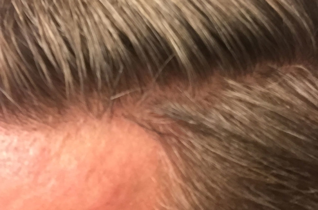 FUE removal of 450 prior placed grafts that were placed too low. The patient desired a more conservative natural-appearing hairline after photo