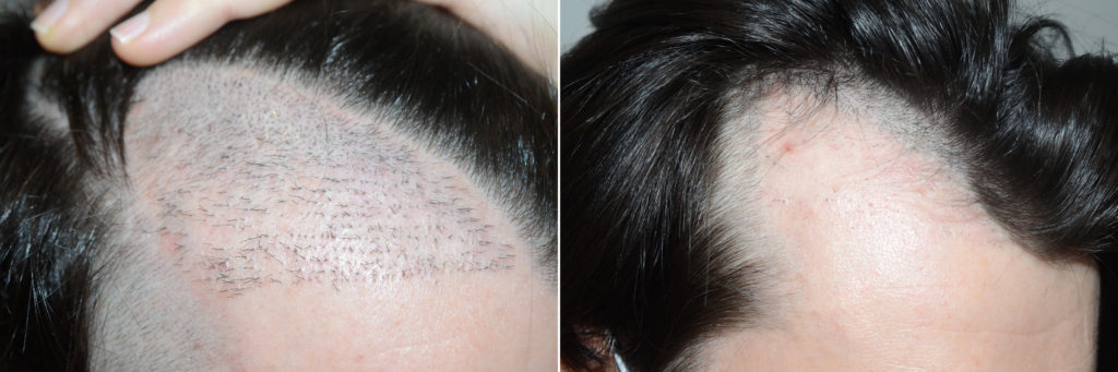 Before and After FUE Removal of 850 prior grafts. Note the essentially normal appearing appearance of the skin afterwards
