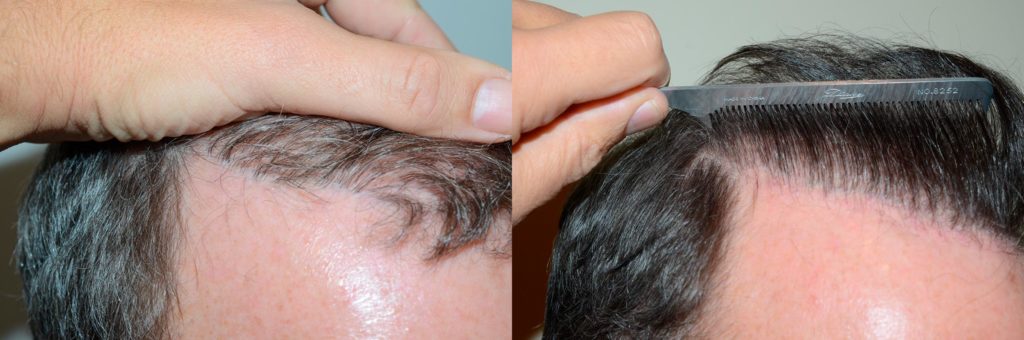 Before and after reparative hairline procedure photo