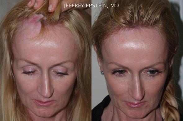 Hair reparative procedure frontal view before and after patient 2