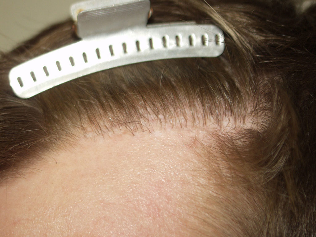 Another example of surgical hairline excision- in this case, only a portion of the hairline was excised before photo