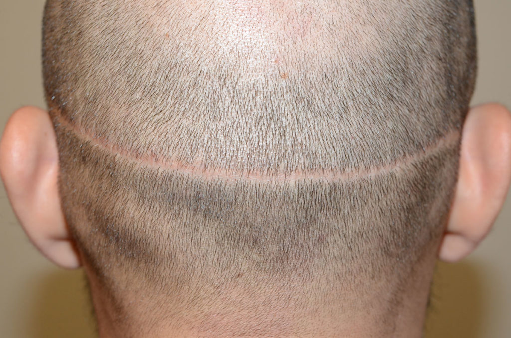 Before and after FUE hair grafting into a prior linear donor site scar before photo