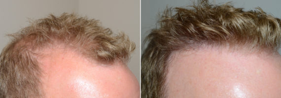 Trasplante de Pelo en Hombres Before and after in Miami, FL, Paciente 109996