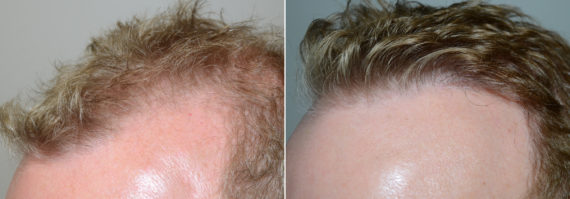 Trasplante de Pelo en Hombres Before and after in Miami, FL, Paciente 109996