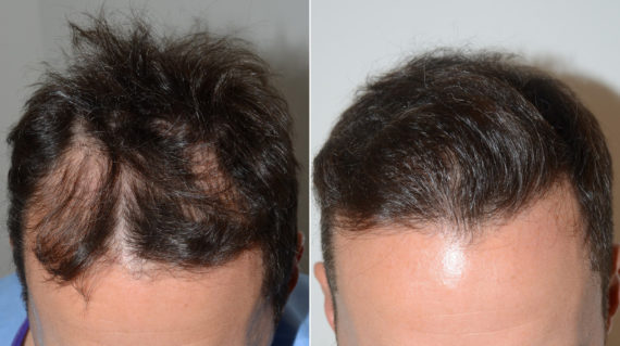 Trasplante de Pelo en Hombres Before and after in Miami, FL, Paciente 110230