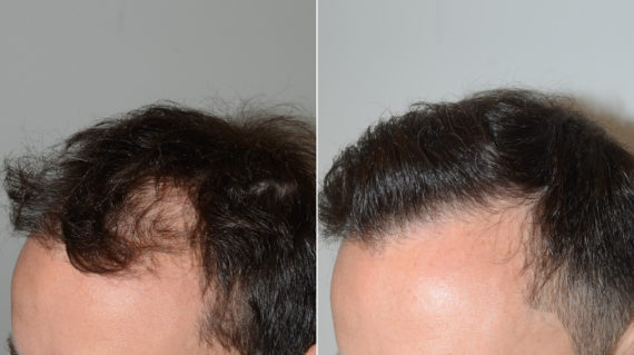 Trasplante de Pelo en Hombres Before and after in Miami, FL, Paciente 110230