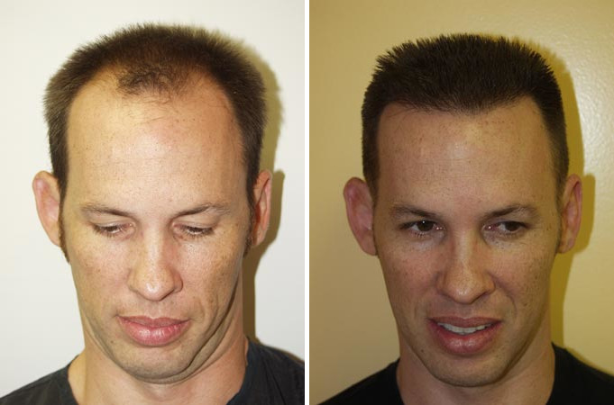 Trasplante de Pelo en Hombres Before and after in Miami, FL, Paciente 86957