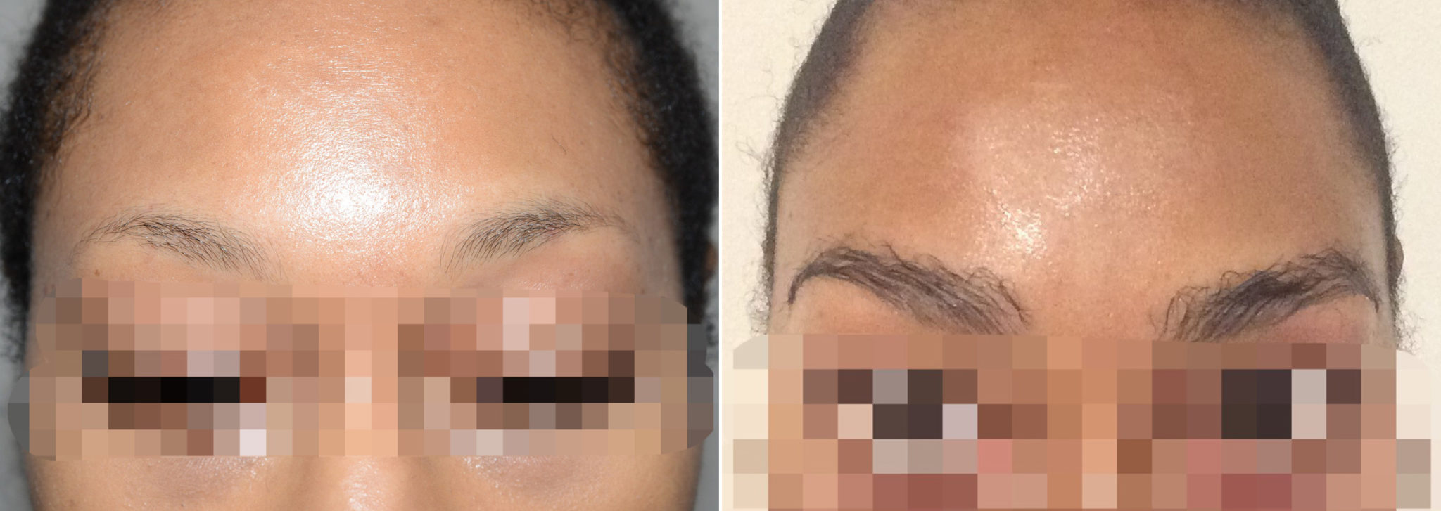 Eyebrow Hair Transplant Photos Miami Fl Patient110760