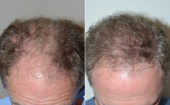 Trasplante de Pelo en Hombres Before and after in Miami, FL, Paciente 108675