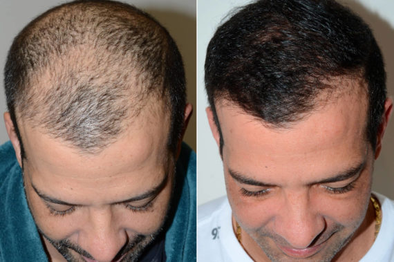 Trasplante de Pelo en Hombres Before and after in Miami, FL, Paciente 74291