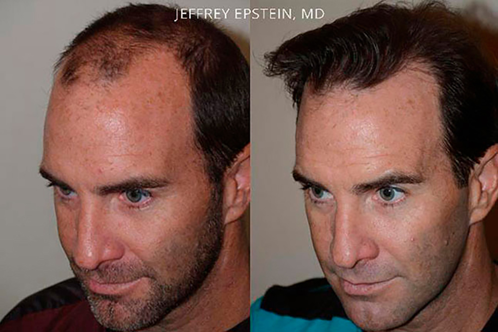 Male Non Surgical Hair Replacement Ph 