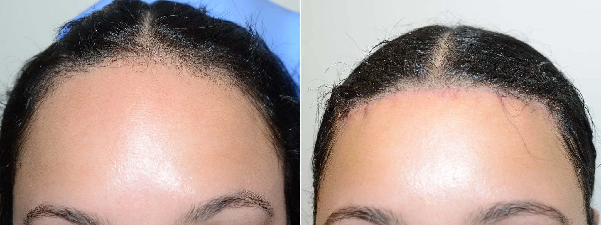 Hair Transplants For Women Before And After Photos Foundation For Hair Restoration 5460