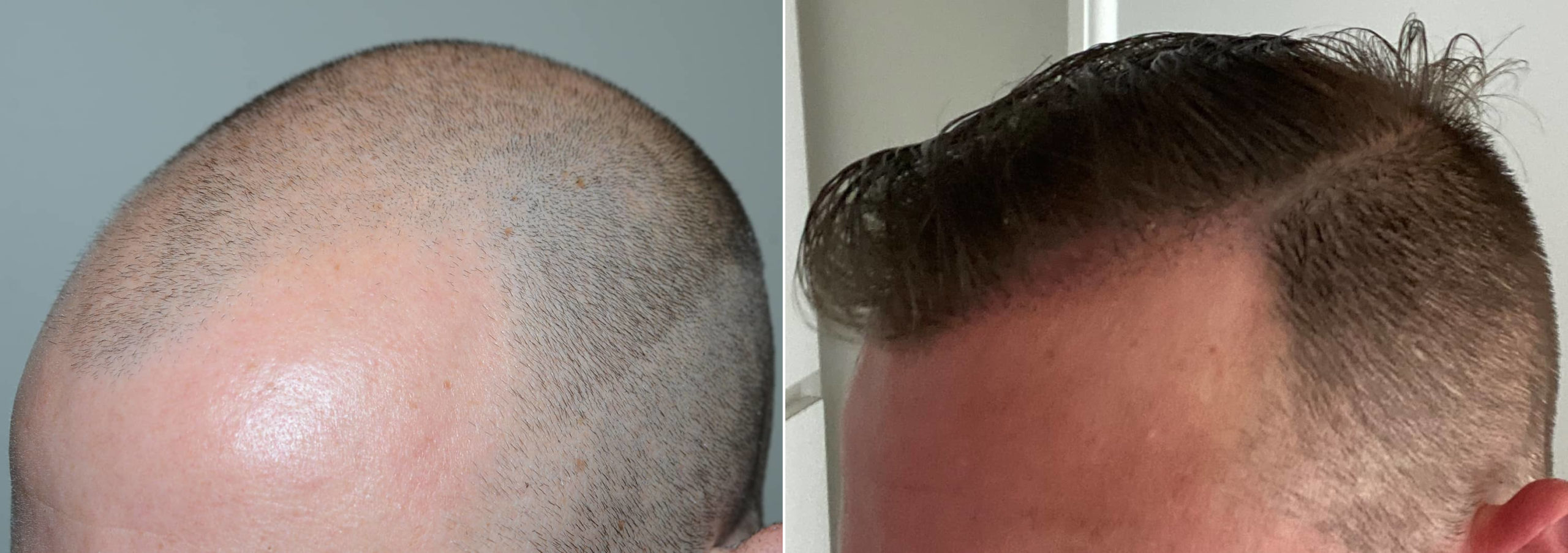 Before- After - Hair Transplant Results - - DREmrah CINIK