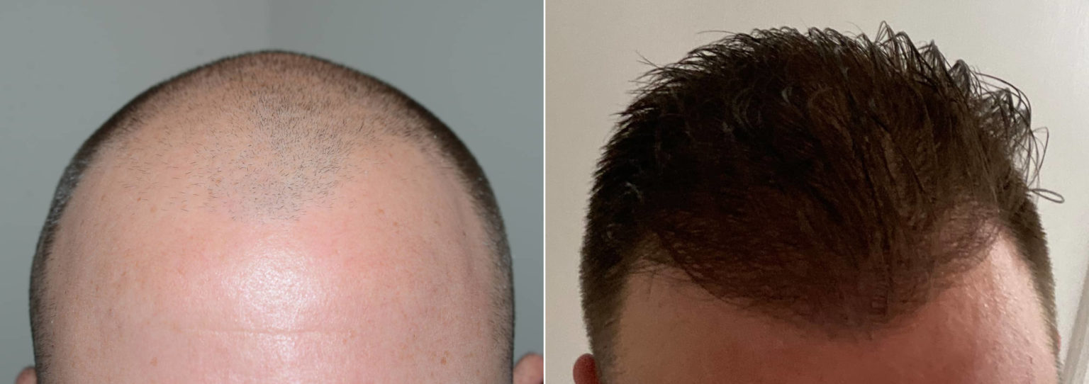 Hair Transplant Miami 