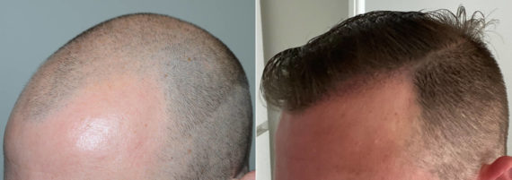 Trasplante de Pelo en Hombres Before and after in Miami, FL, Paciente 117310