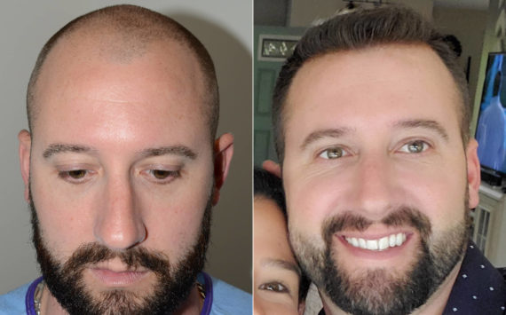 Trasplante de Pelo en Hombres Before and after in Miami, FL, Paciente 117310