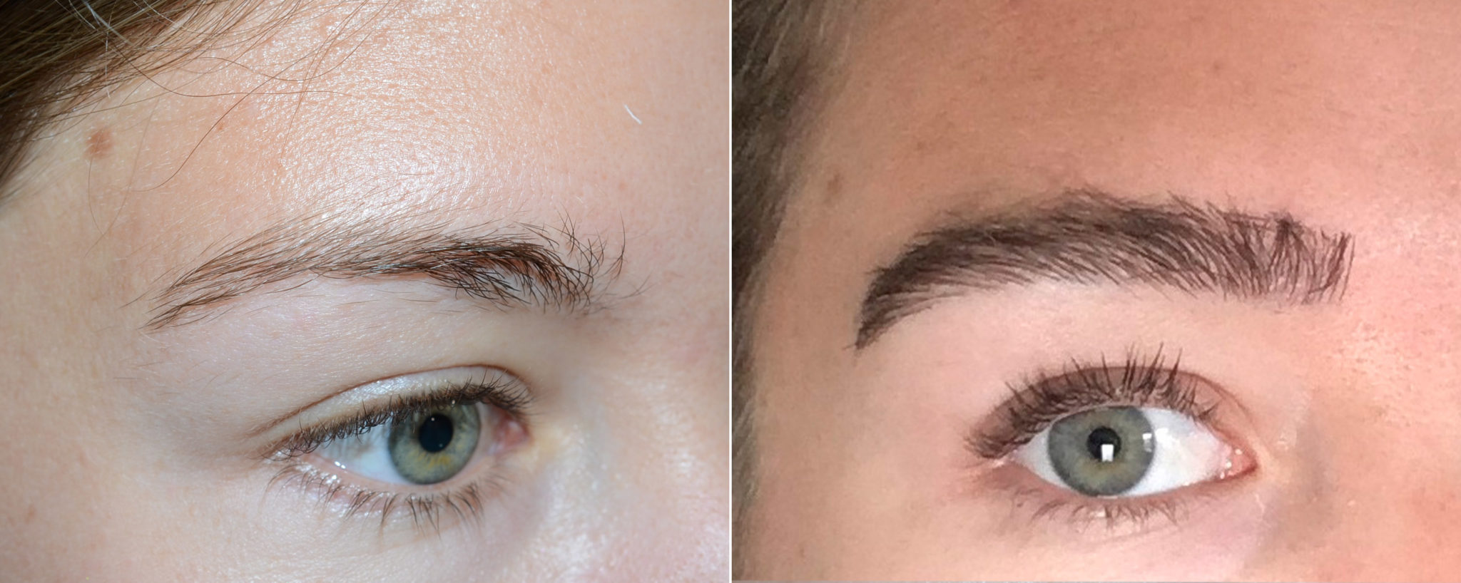 Eyebrow Photos Foundation For Hair Restoration 5446