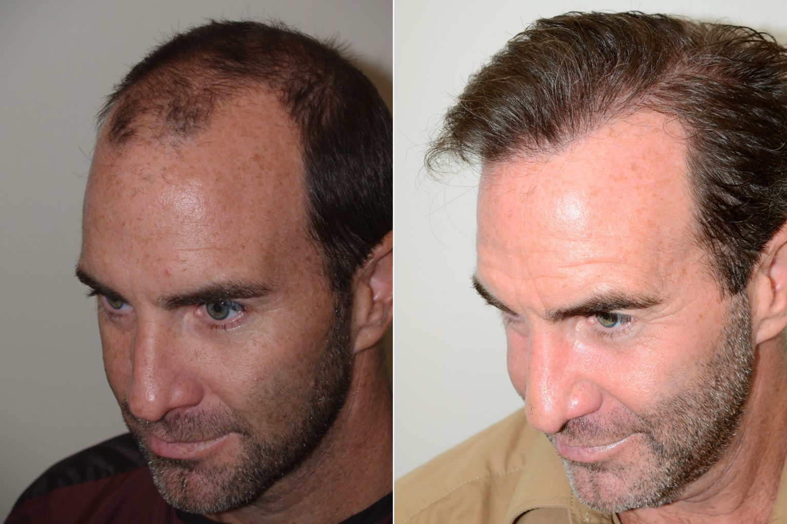 Hair Transplants for Men photos Miami, FL Patient117518