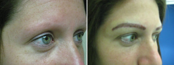 Trasplante de Cejas Before and after in Miami, FL, Paciente 67620