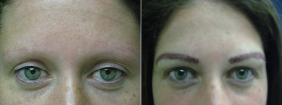 Trasplante de Cejas Before and after in Miami, FL, Paciente 67620