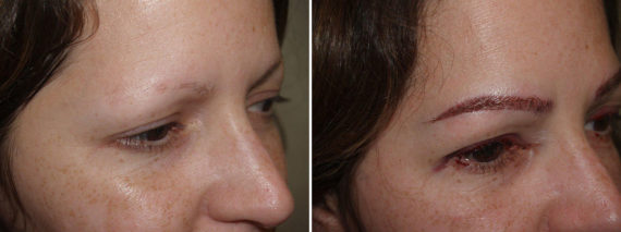 Trasplante de Cejas Before and after in Miami, FL, Paciente 67691