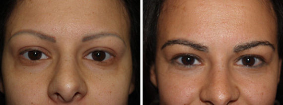 Trasplante de Cejas Before and after in Miami, FL, Paciente 69118