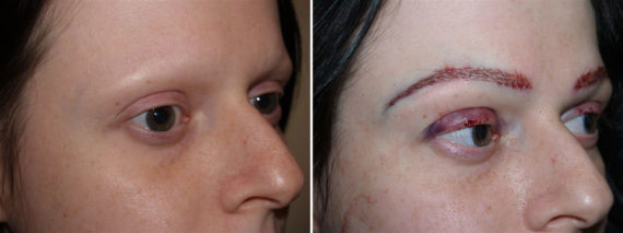 Trasplante de Cejas Before and after in Miami, FL, Paciente 69191