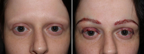 Trasplante de Cejas Before and after in Miami, FL, Paciente 69191