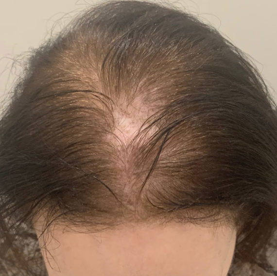 Scalp Micropigmentation Miami | Foundation For Hair Restoration